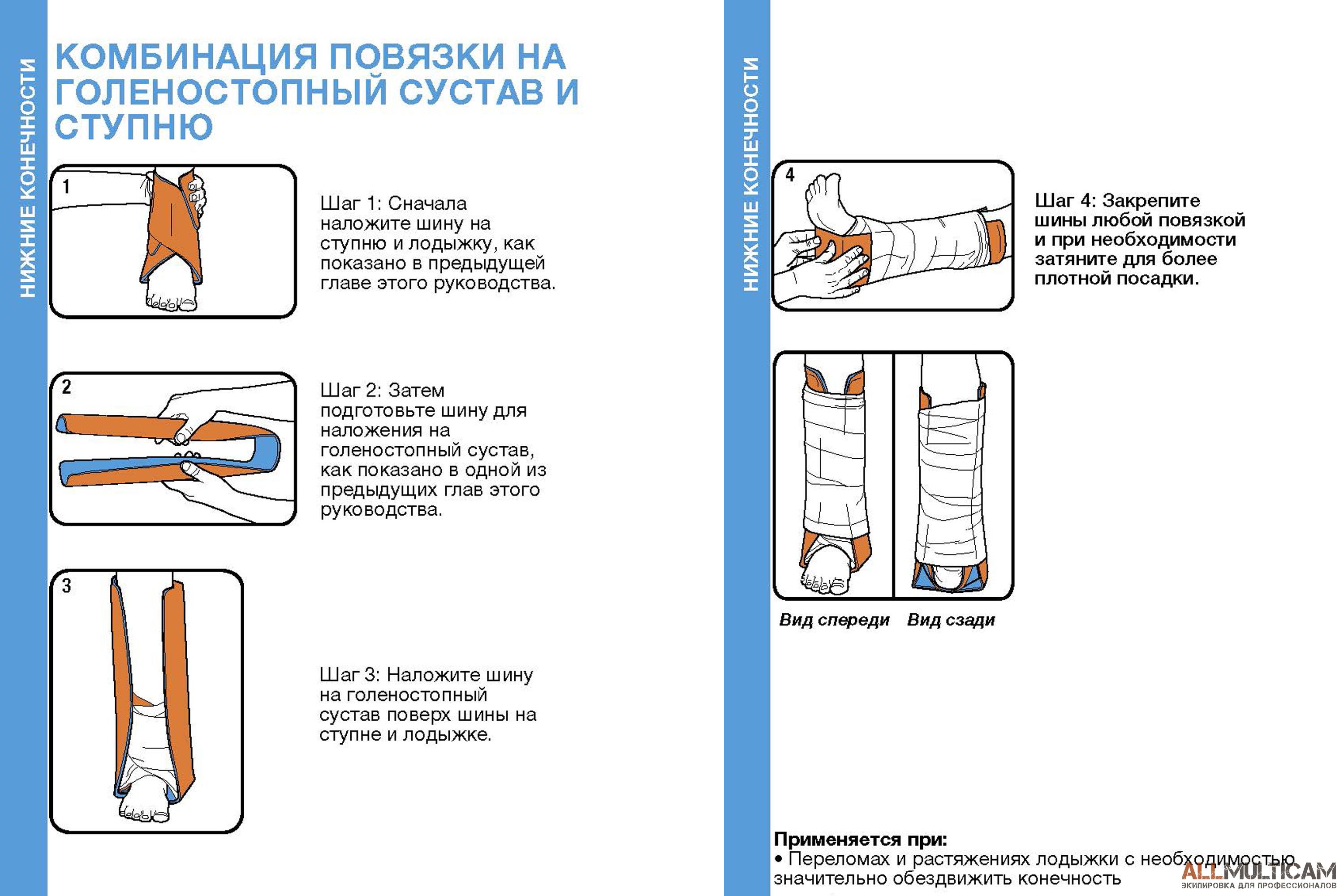 Как наложить шину 37 Как наложить шину 34