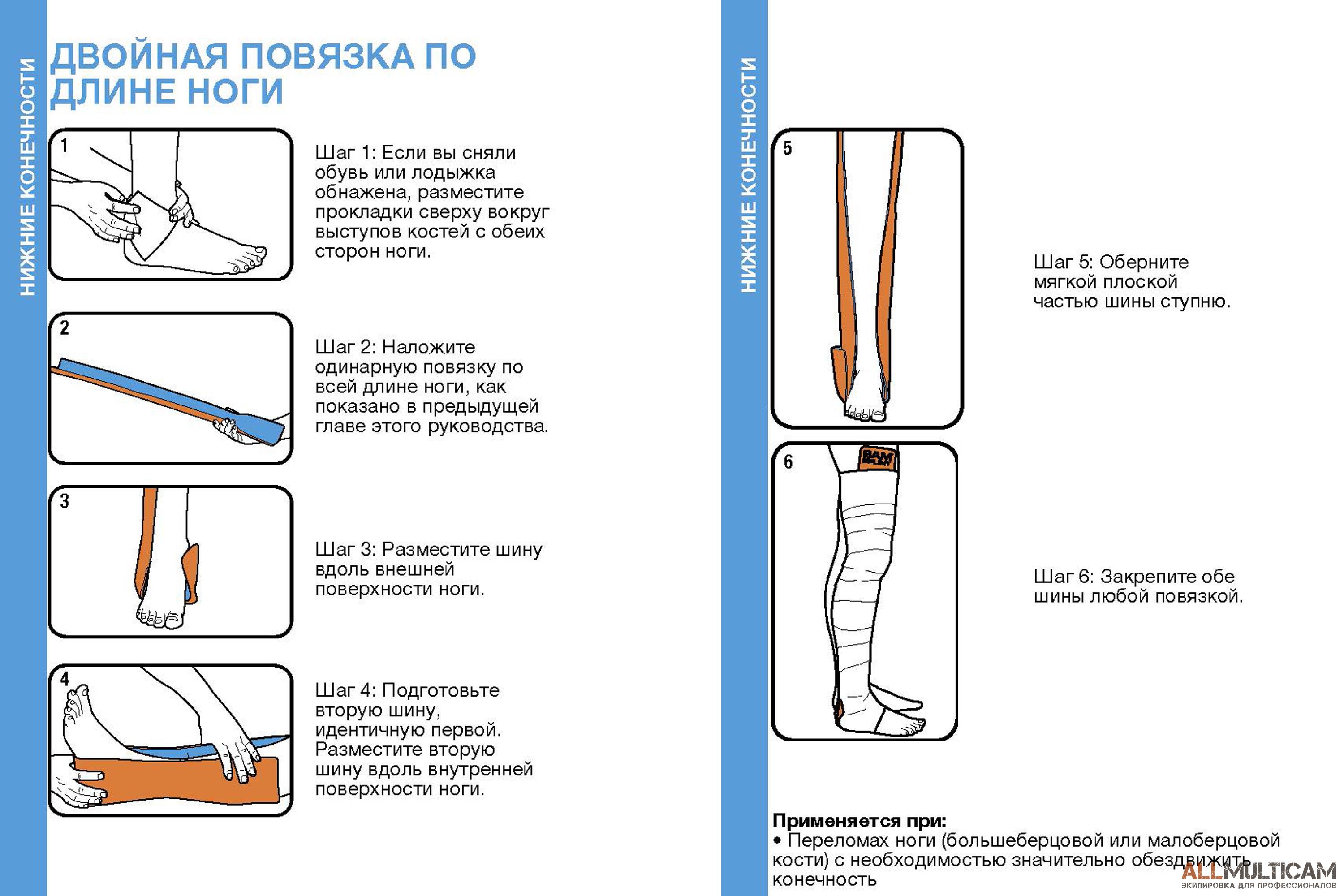 Шина Sam Splint - это самая популярная экстренная шина в мире