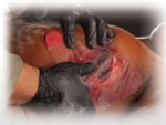 Прозрачный клейкий пластырь (6х6 дюймов) HyFin Chest Seal North American Rescue